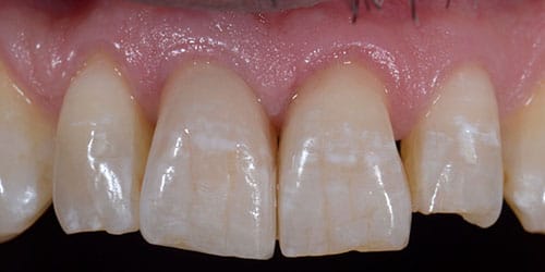 Tooth Replacement - Implant Dentistry 1 - After