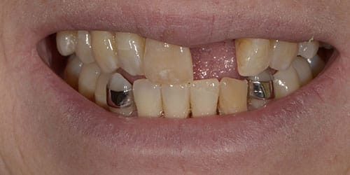 Tooth Replacement - Maryland Bridge 1 - Before