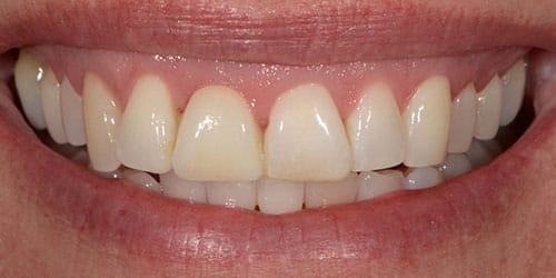 Tooth Replacement - Maryland Bridge 2 - After