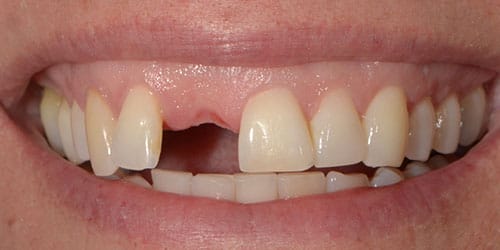 Tooth Replacement - Maryland Bridge 2 - Before