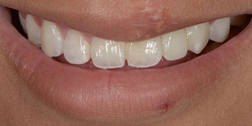 Tooth Replacement - Maddie 2 - After