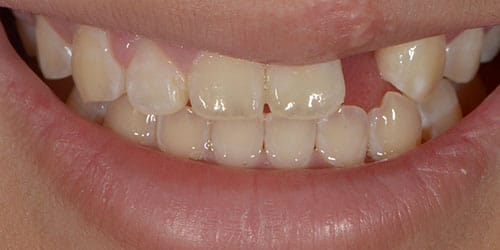 Tooth Replacement - Maddie 2 - Before