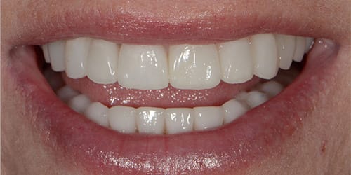 Tooth Replacement - Shannon - After
